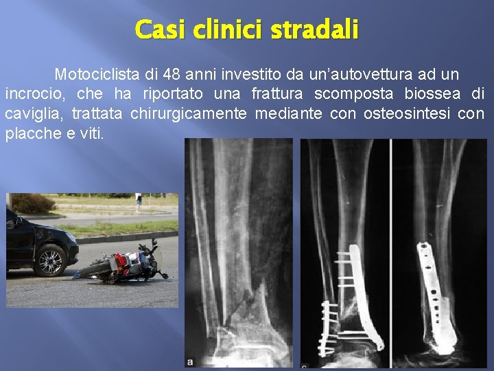 Casi clinici stradali Motociclista di 48 anni investito da un’autovettura ad un incrocio, che