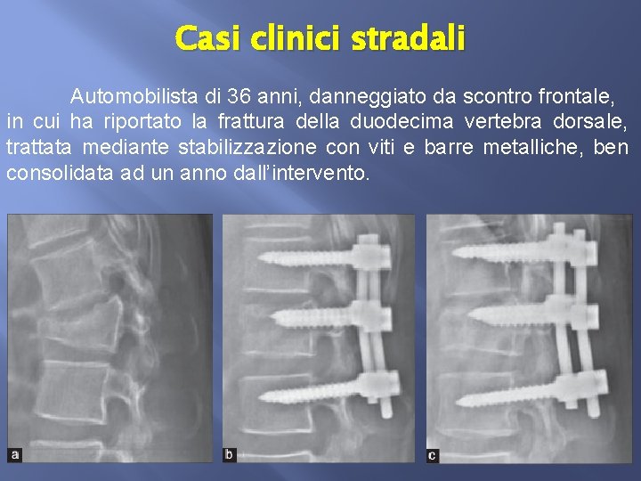 Casi clinici stradali Automobilista di 36 anni, danneggiato da scontro frontale, in cui ha