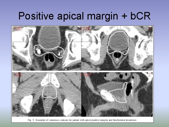 Positive apical margin + b. CR 