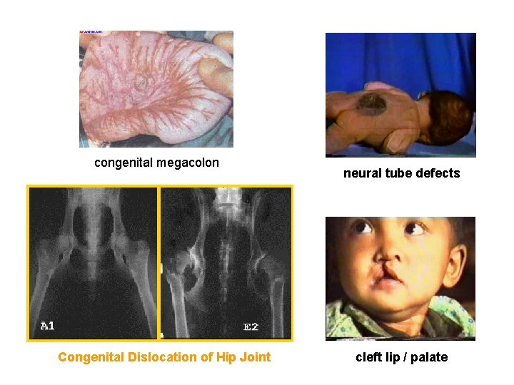 congenital megacolon Congenital Dislocation of Hip Joint neural tube defects cleft lip / palate