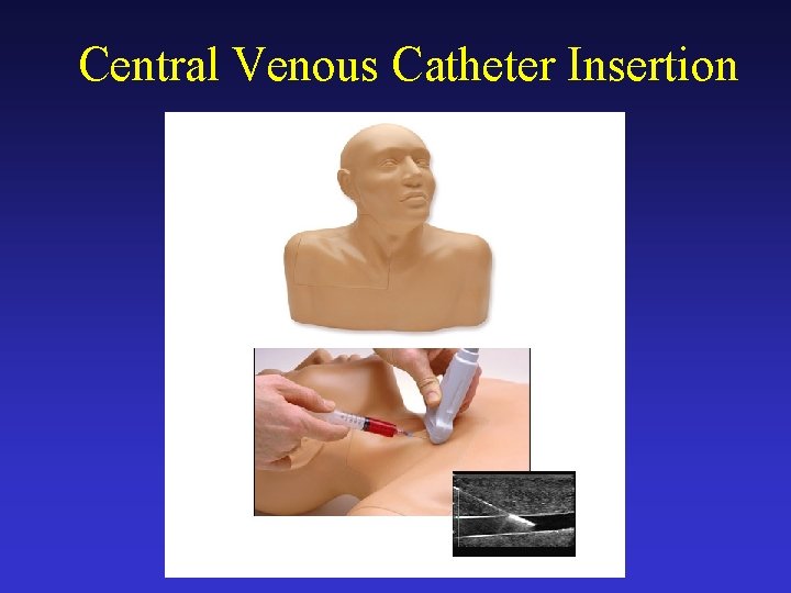Central Venous Catheter Insertion 
