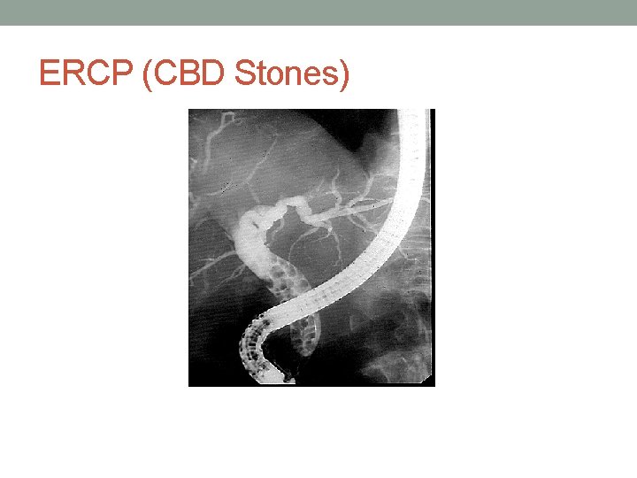 ERCP (CBD Stones) 