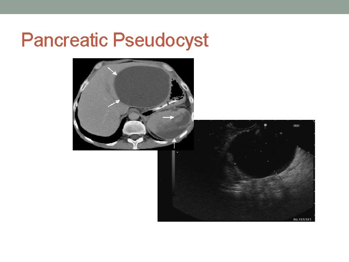 Pancreatic Pseudocyst 