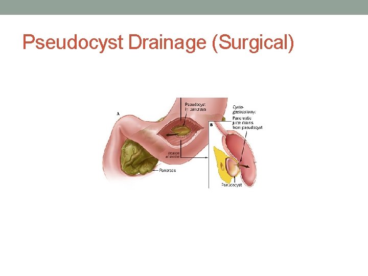 Pseudocyst Drainage (Surgical) 