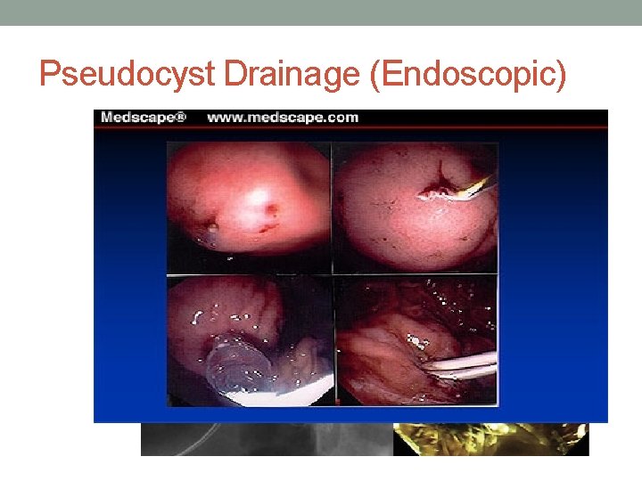 Pseudocyst Drainage (Endoscopic) 