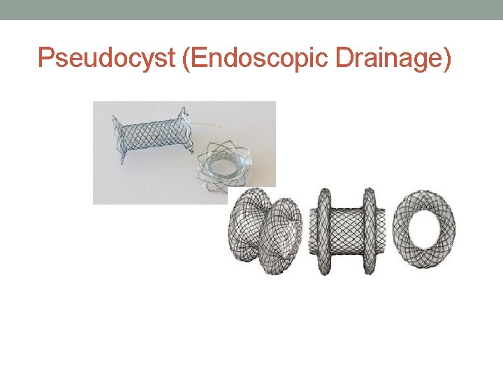 Pseudocyst (Endoscopic Drainage) 