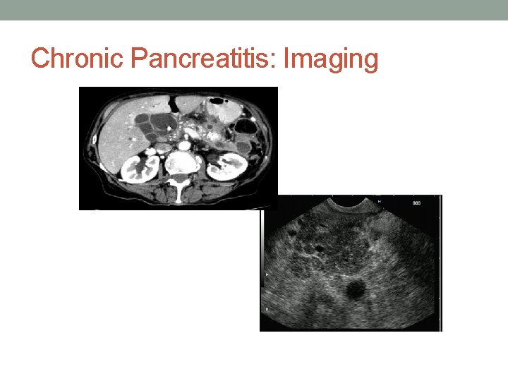 Chronic Pancreatitis: Imaging 