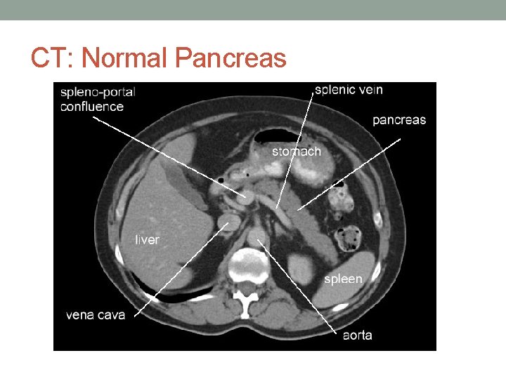 CT: Normal Pancreas 