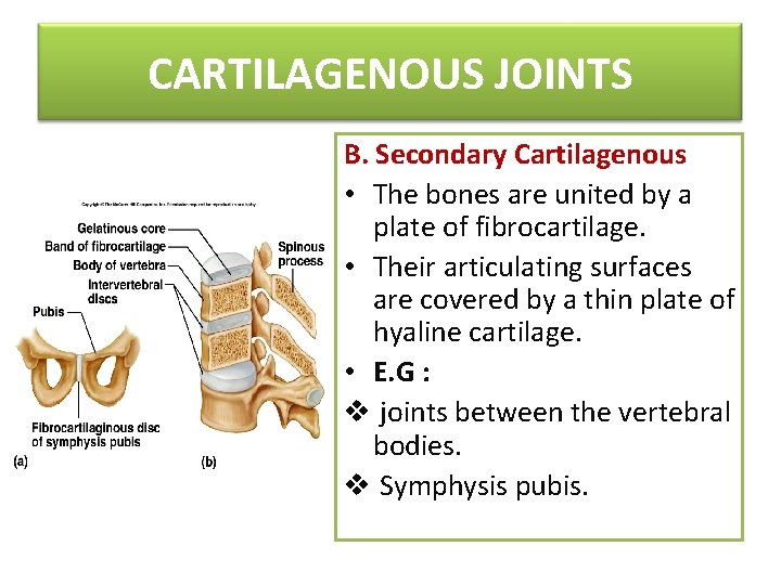 CARTILAGENOUS JOINTS B. Secondary Cartilagenous • The bones are united by a plate of