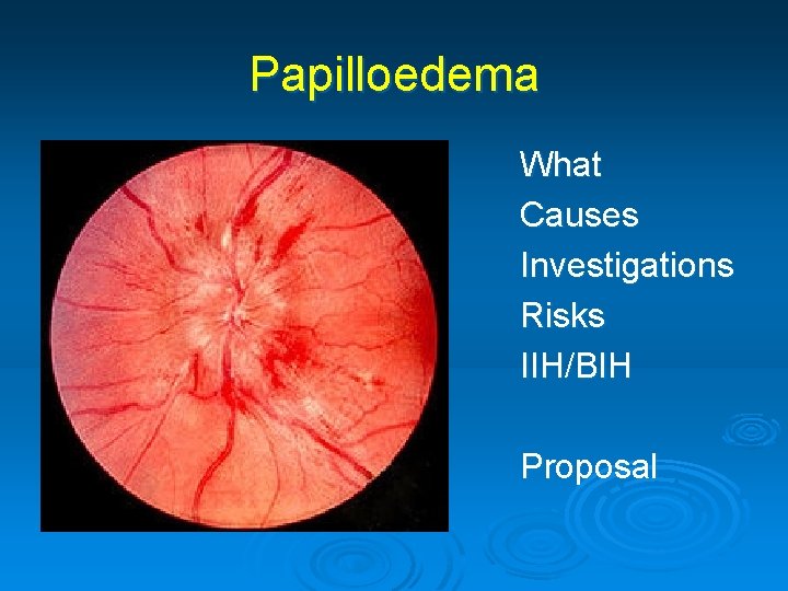 Papilloedema What Causes Investigations Risks IIH/BIH Proposal 