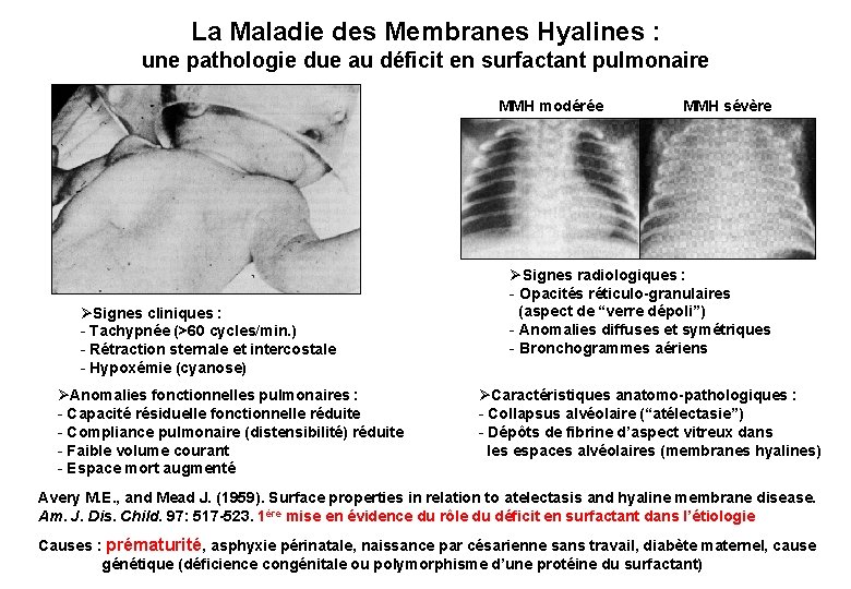 La Maladie des Membranes Hyalines : une pathologie due au déficit en surfactant pulmonaire