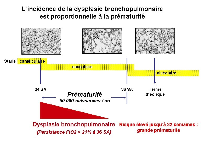 L’incidence de la dysplasie bronchopulmonaire est proportionnelle à la prématurité Stade canaliculaire sacculaire alvéolaire