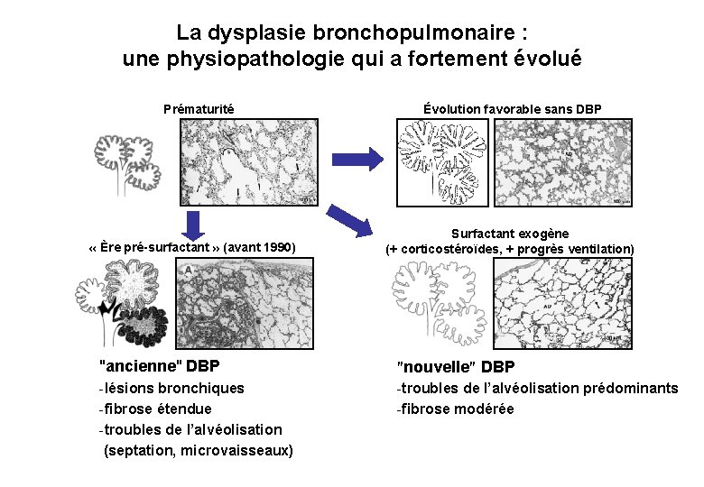 La dysplasie bronchopulmonaire : une physiopathologie qui a fortement évolué Prématurité « Ère pré-surfactant