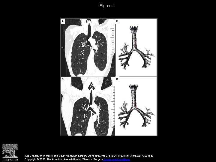 Figure 1 The Journal of Thoracic and Cardiovascular Surgery 2018 1552746 -2754 DOI: (10.