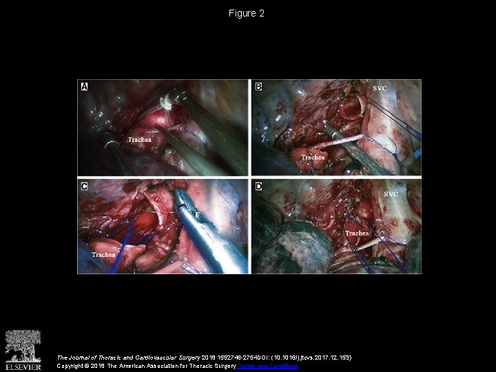 Figure 2 The Journal of Thoracic and Cardiovascular Surgery 2018 1552746 -2754 DOI: (10.