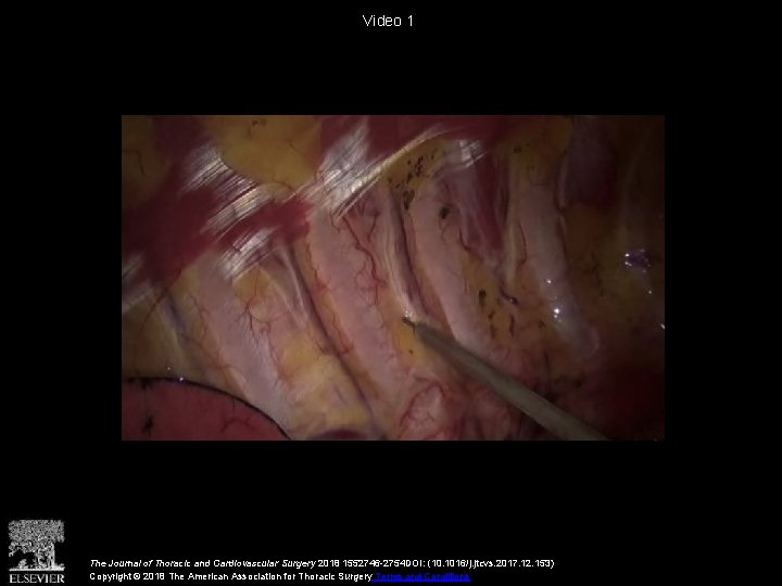 Video 1 The Journal of Thoracic and Cardiovascular Surgery 2018 1552746 -2754 DOI: (10.