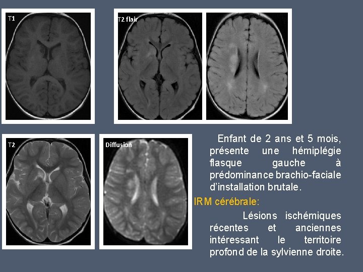 T 1 T 2 flair Diffusion Enfant de 2 ans et 5 mois, présente