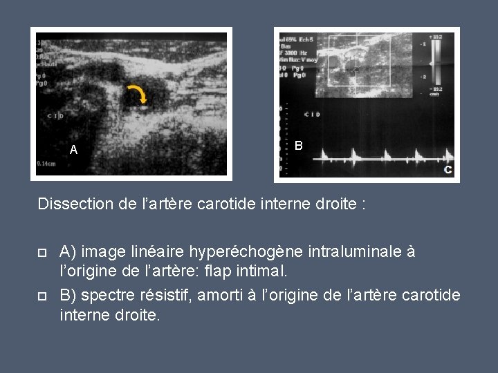 A B Dissection de l’artère carotide interne droite : A) image linéaire hyperéchogène intraluminale