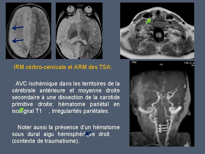 IRM cérbro-cervicale et ARM des TSA: AVC ischémique dans les territoires de la cérébrale