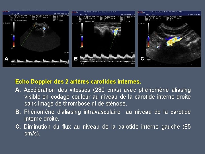 A B C Echo Doppler des 2 artères carotides internes. A. Accélération des vitesses