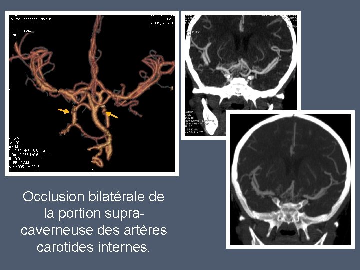 Occlusion bilatérale de la portion supracaverneuse des artères carotides internes. 