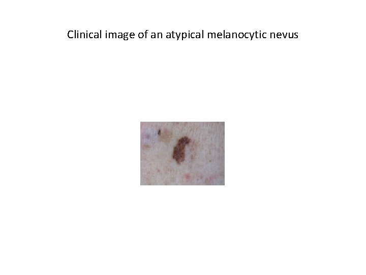 Clinical image of an atypical melanocytic nevus Clinical image of an atypical melanocytic nevus