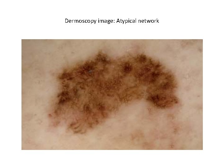 Dermoscopy image: Atypical network Dermoscopy image: Atypical network
