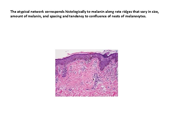 The atypical network corresponds histologically to melanin along rete ridges that vary in size, The atypical network corresponds histologically to melanin along rete ridges that vary in size,