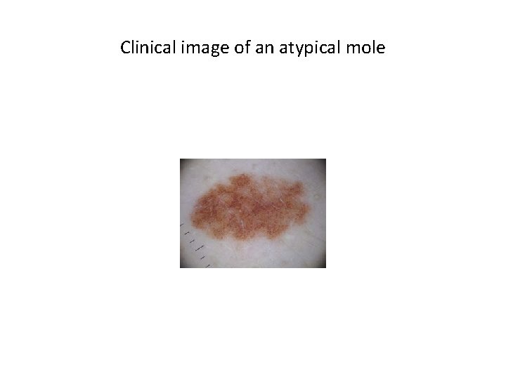 Clinical image of an atypical mole Clinical image of an atypical mole