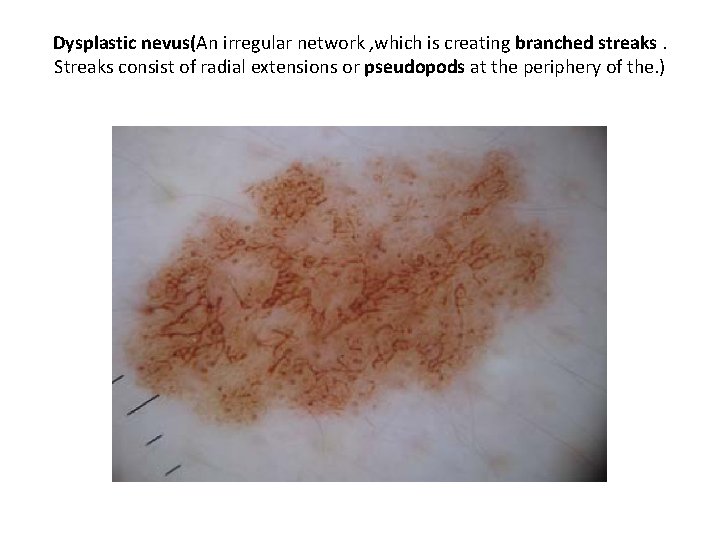 Dysplastic nevus(An irregular network , which is creating branched streaks. Streaks consist of radial Dysplastic nevus(An irregular network , which is creating branched streaks. Streaks consist of radial