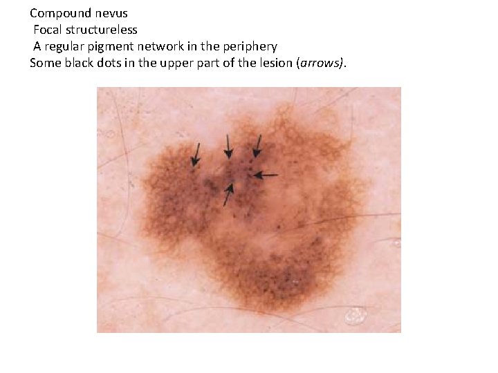 Compound nevus Focal structureless A regular pigment network in the periphery Some black dots Compound nevus Focal structureless A regular pigment network in the periphery Some black dots