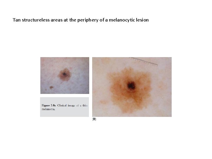 Tan structureless areas at the periphery of a melanocytic lesion Tan structureless areas at the periphery of a melanocytic lesion