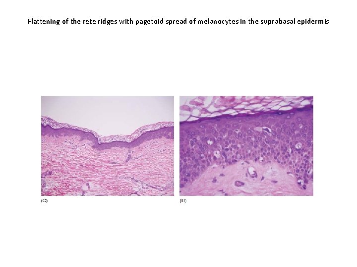 Flattening of the rete ridges with pagetoid spread of melanocytes in the suprabasal epidermis Flattening of the rete ridges with pagetoid spread of melanocytes in the suprabasal epidermis