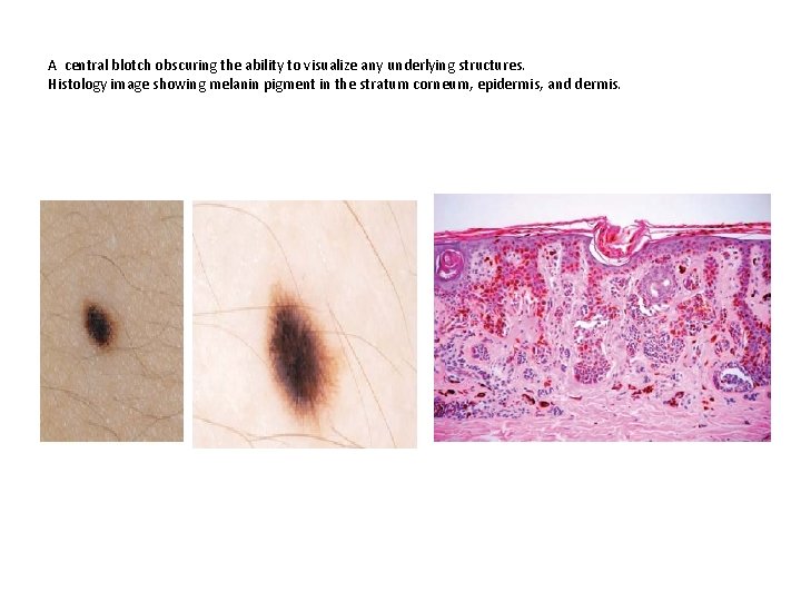 A central blotch obscuring the ability to visualize any underlying structures. Histology image showing A central blotch obscuring the ability to visualize any underlying structures. Histology image showing