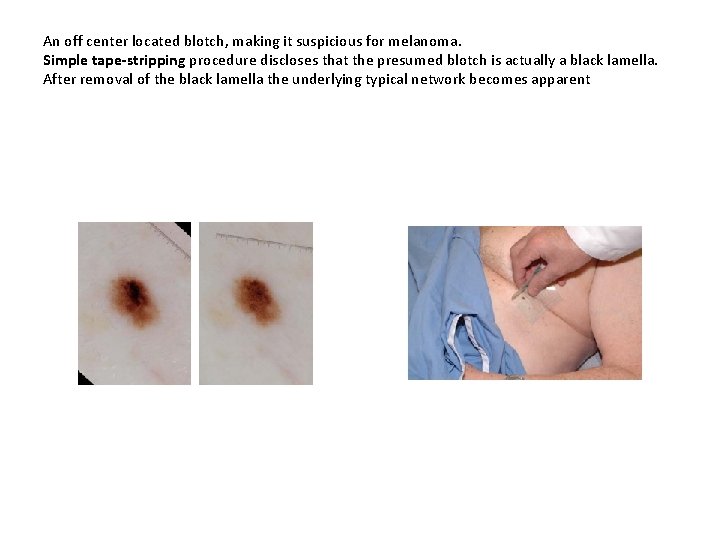 An off center located blotch, making it suspicious for melanoma. Simple tape-stripping procedure discloses An off center located blotch, making it suspicious for melanoma. Simple tape-stripping procedure discloses