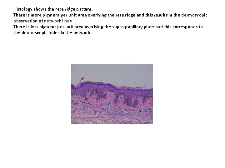 Histology shows the rete ridge pattern. There is more pigment per unit area overlying Histology shows the rete ridge pattern. There is more pigment per unit area overlying