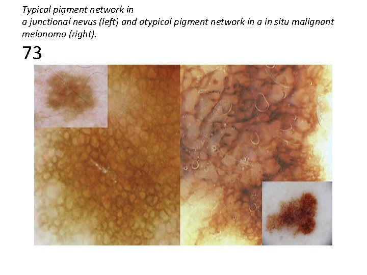 Typical pigment network in a junctional nevus (left) and atypical pigment network in a Typical pigment network in a junctional nevus (left) and atypical pigment network in a