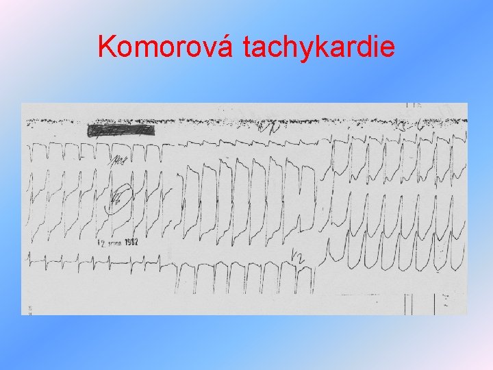 Komorová tachykardie 