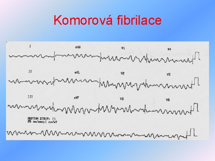 Komorová fibrilace 