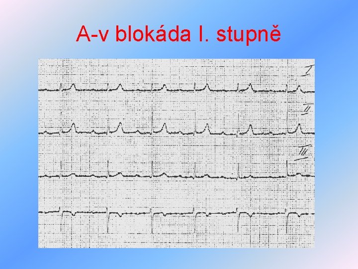 A-v blokáda I. stupně 