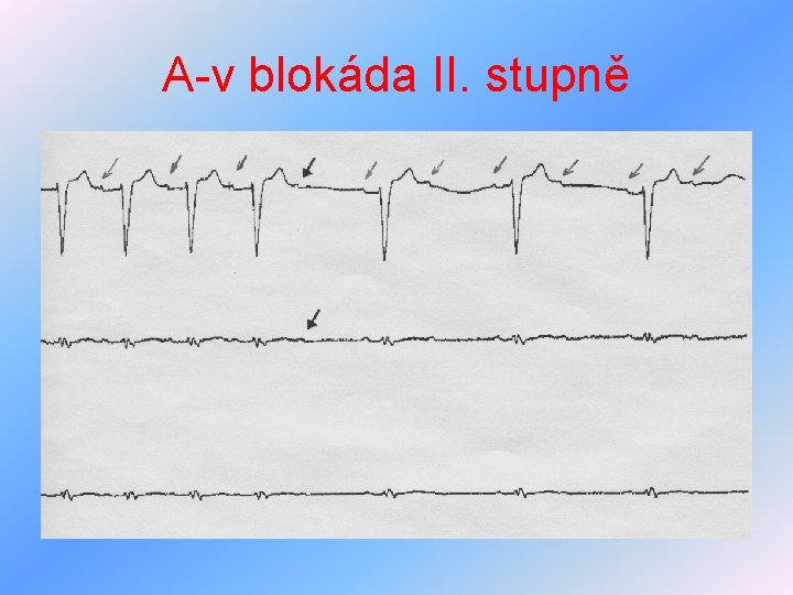 A-v blokáda II. stupně 