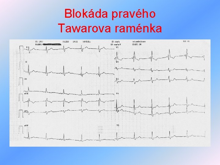 Blokáda pravého Tawarova raménka 