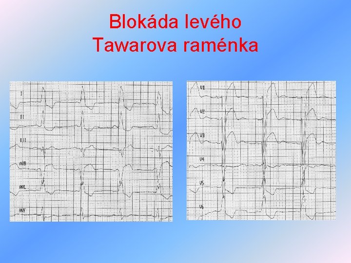 Blokáda levého Tawarova raménka 