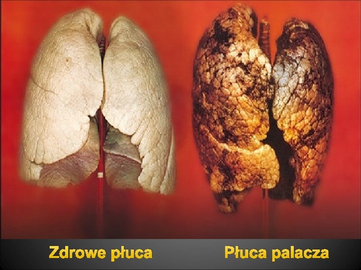 Zdrowe płuca Płuca palacza 