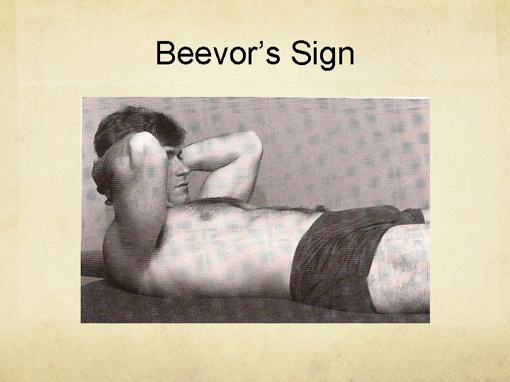 Beevor’s Sign 