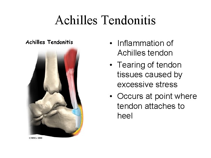 Achilles Tendonitis • Inflammation of Achilles tendon • Tearing of tendon tissues caused by