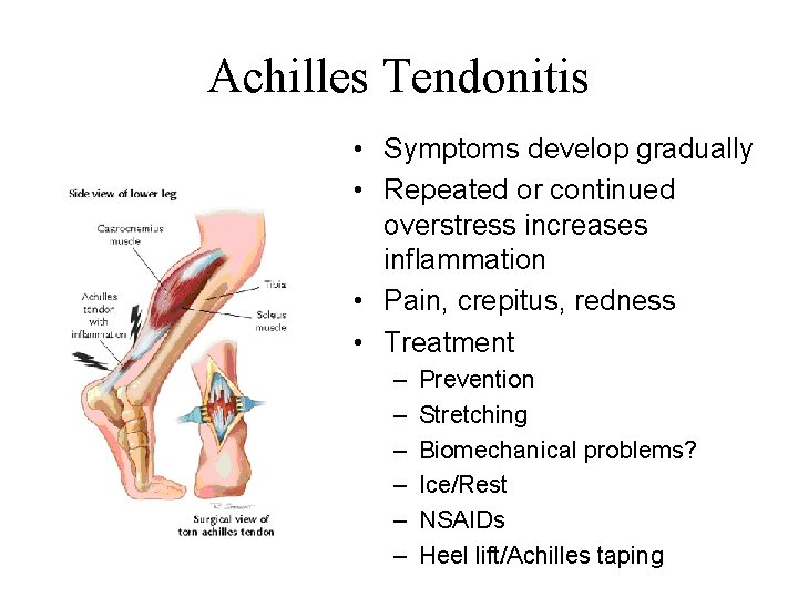 Achilles Tendonitis • Symptoms develop gradually • Repeated or continued overstress increases inflammation •