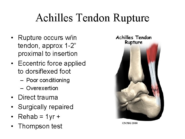 Achilles Tendon Rupture • Rupture occurs w/in tendon, approx 1 -2” proximal to insertion