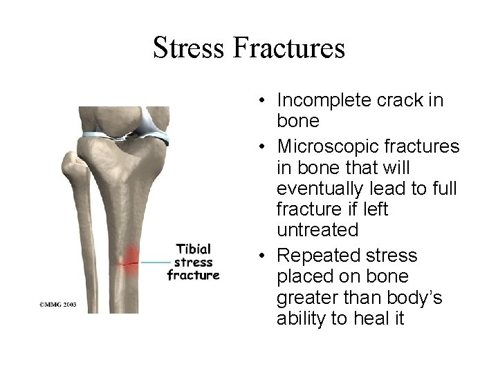 Stress Fractures • Incomplete crack in bone • Microscopic fractures in bone that will