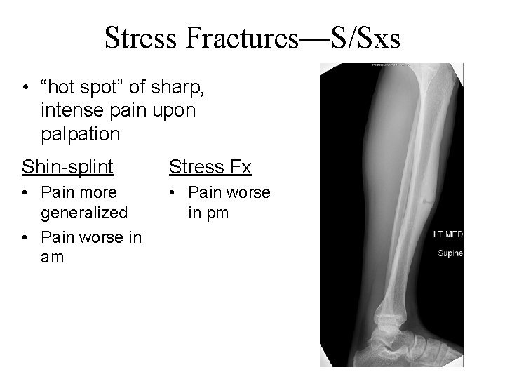 Stress Fractures—S/Sxs • “hot spot” of sharp, intense pain upon palpation Shin-splint Stress Fx